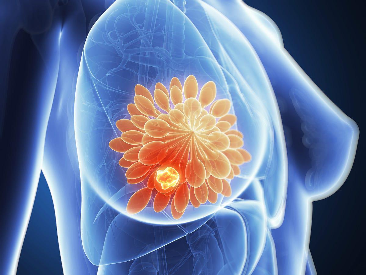 令人惊讶的统计：年轻女性乳腺癌的增长趋势